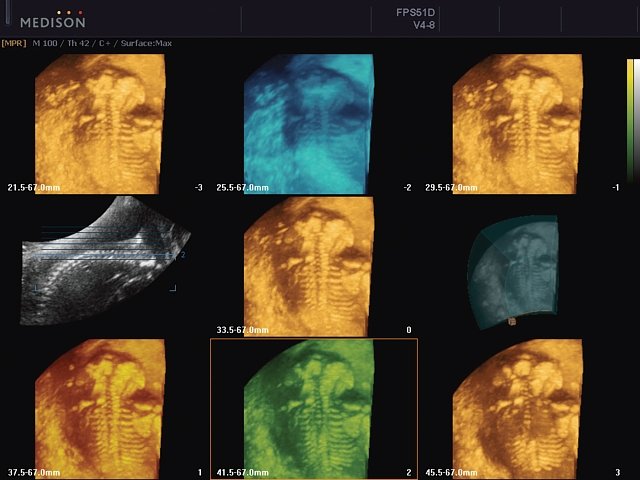 Multi Volume Slice - позвоночник плода