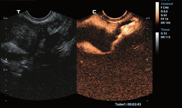 Свободно проходимые маточные трубы: режим 2D-contrast ЭхоГСГ