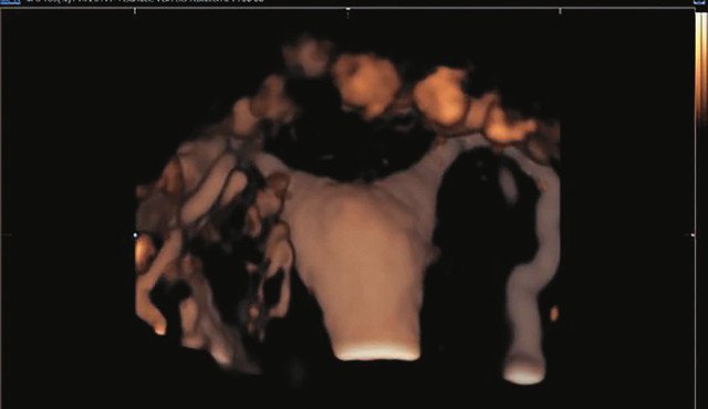 Свободно проходимые маточные трубы с обеих сторон: визуализация контраста в периовариальных пространствах с двух сторон (режим 3D-contrast ЭхоГСГ)