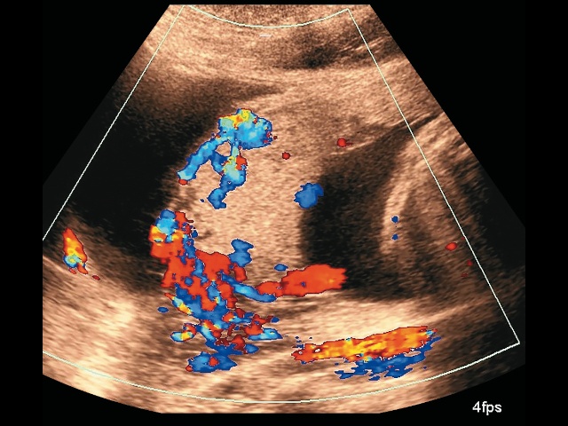 Беременность 28+6 нед. PAS: утеровезикальная гиперваскуляризация. Режим ЦДК