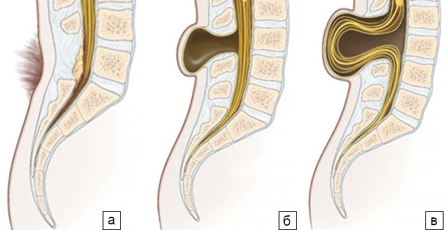 Схема расположения патологии spina bifida