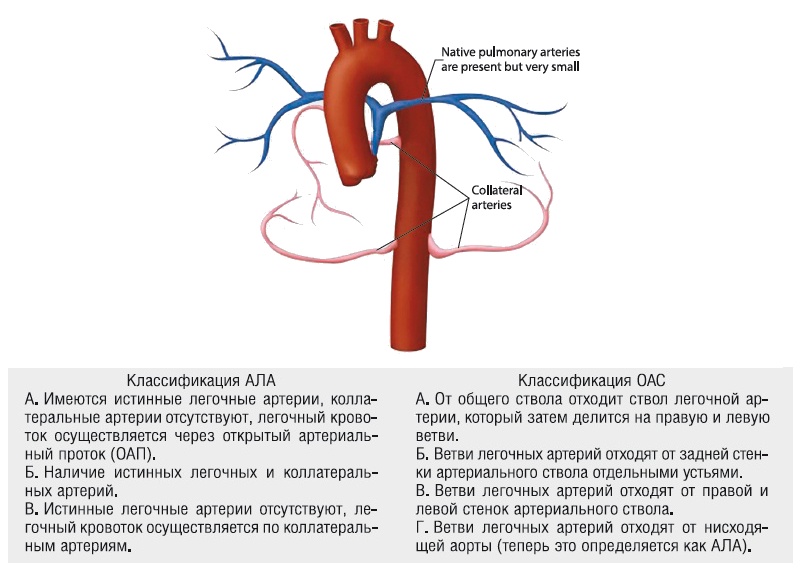 Схема артерий, кровоснабжающих легкие при единственном артериальном стволе: синим цветом окрашены истинные легочные артерии, розовым цветом - боталлов проток и БАЛКА. Классификации АЛА и ОАС представлены в упрощенном виде