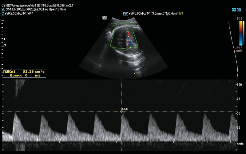 Измерение максимальной систолической скорости в среднемозговой артерии у плода