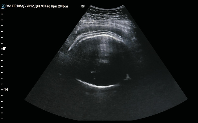 Двойной контур головки плода при диабетической фетопатии