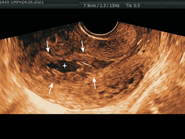 Среднесагиттальный срез матки. Видны расширенная полость (звездочка) с утолщенным эндометрием (стрелки) и интактная шейка матки