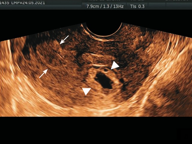 По задней стенке матки в средней трети видно ПЯ с типичной картиной, с наличием желточного мешка и эмбрионального полюса (наконечники стрелок), стрелками отмечена полость матки