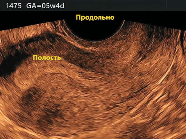 Среднесагиттальный срез матки - полость матки не расширена, эндометрий 12 мм, определяется асимметрия толщины передней и задней стенок матки. Картина шейки матки в норме