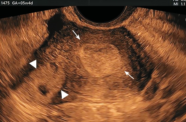 Поперечный срез матки - отражена картина ПЯ в виде эхогенной округлой массы с центральным жидкостным включением (наконечники стрелок), расположенной отдельно от полости матки (стрелки) и деформирующей с латеральной стороны наружный контур матки