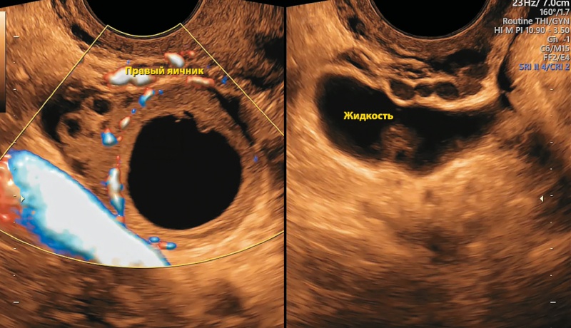 Ультразвуковая картина правого яичника с желтым телом и межсвязочная свободная жидкость