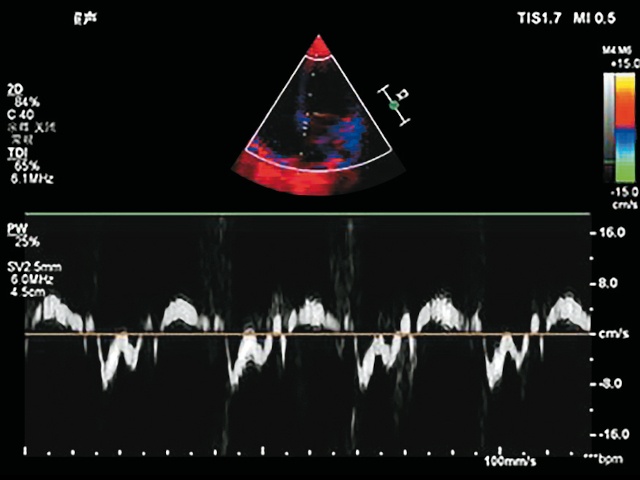Тканевая допплерография септального участка митрального кольца