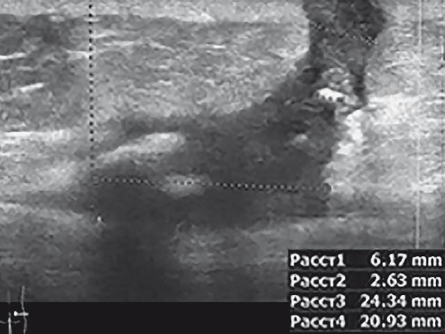 УЗИ мягких тканей правой ягодичной области после санации свищевого хода - поперечная проекция