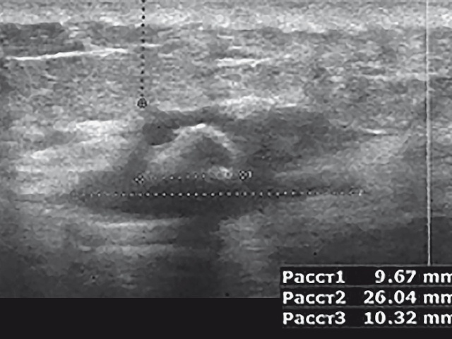 УЗИ мягких тканей правой ягодичной области после санации свищевого хода - продольная проекция