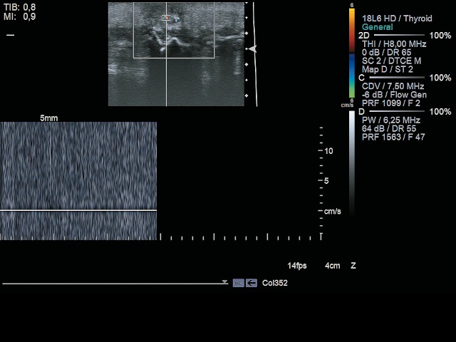  УЗИ мягких тканей левой ягодицы - режим спектрального допплера: видны плотно расположенные вертикальные линии - допплеровский сигнал без спектра (шум)