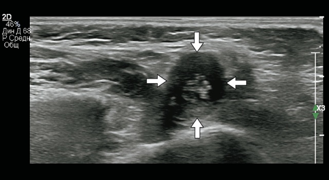 Эхограмма подкожного образования, в центре которого располагаются трубчатые гиперэхогенные структуры, подвижные в режиме реального времени (В-режим, поперечная проекция)