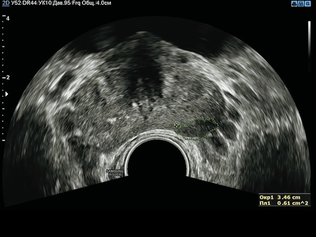 УЗИ предстательной железы - трассировка изображения (а)