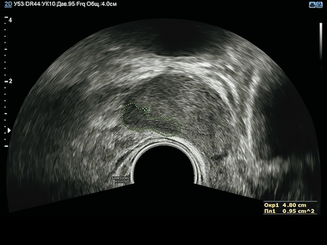 УЗИ предстательной железы - трассировка изображения (б)