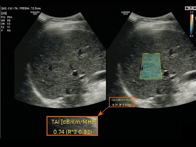 Эхограмма и измерение в режиме визуализации ослабления в ткани (TAI) у пациента без стеатоза печени