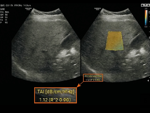 Эхограмма и измерение в режиме визуализации ослабления в ткани (TAI) у пациента со стеатозом печени