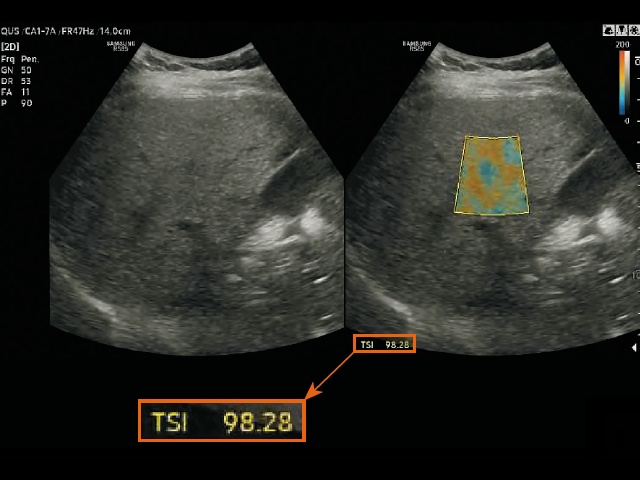 Эхограмма и измерение в режиме визуализации распределения рассеяния в ткани (TSI) у пациента со стеатозом печени
