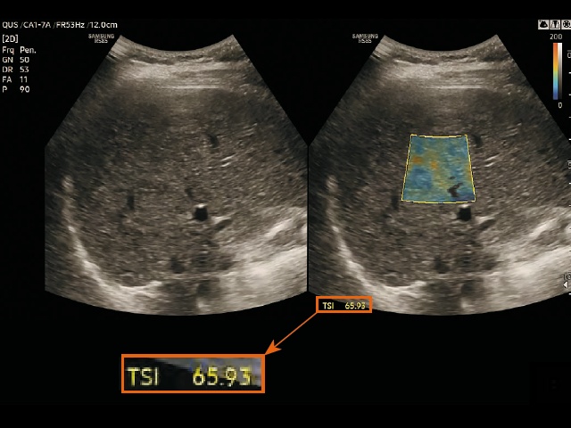 Эхограмма и измерение в режиме визуализации распределения рассеяния в ткани (TSI) у пациента со стеатозом печени