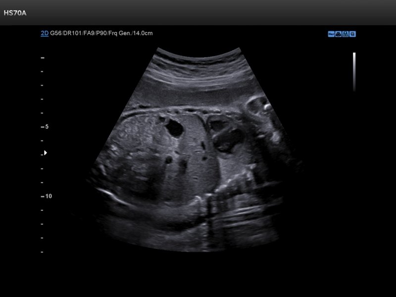 Normal Fetal Abdomen Ultrasound