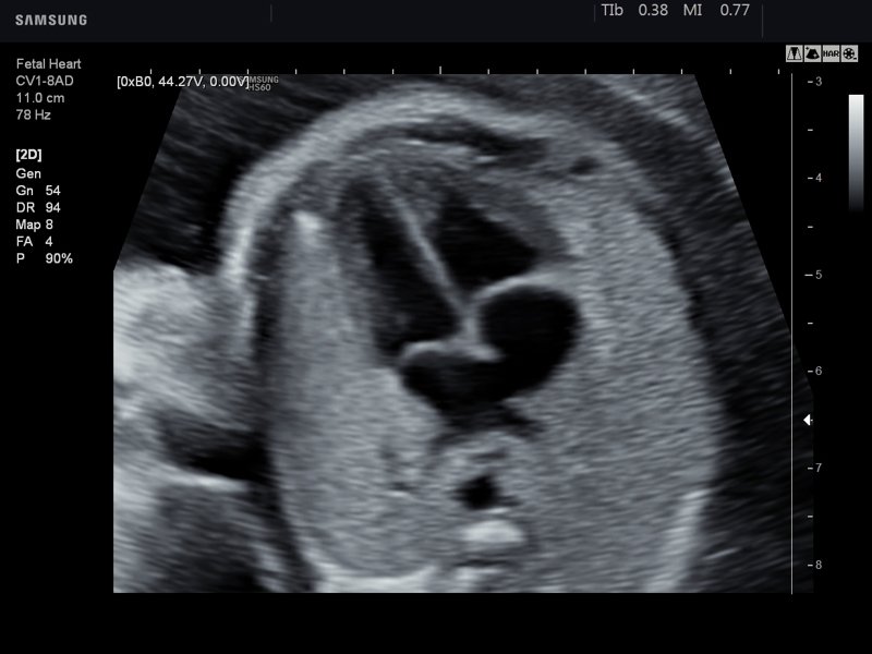 Fetal Heart Images Ultrasound / John simpson, provides effective ...