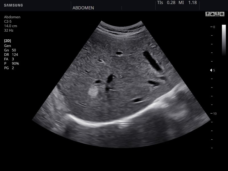 Ultrasound images • Liver, B-mode, echogramm №847