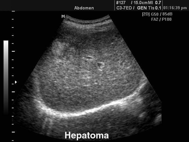 Ultrasound images • Hepatoma, B-mode, echogramm №103