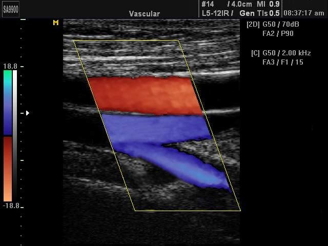 Ultrasound Images • Superficial Femoral Artery Color Doppler