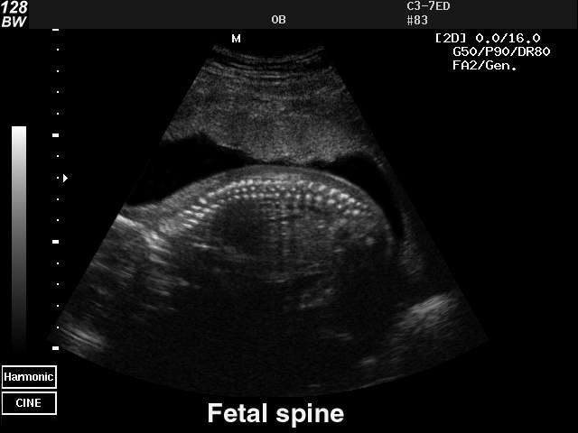Ultrasound images • Fetal spine, B-mode, echogramm №40