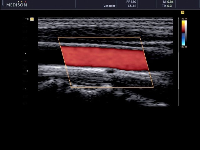 MEDISON.RU - Common carotid artery, color doppler (№473, U5)