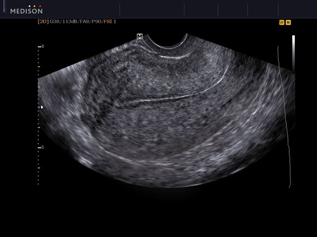 Ultrasound images • Uterus, B-mode, echogramm №558