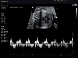 Fetal heart, PW doppler