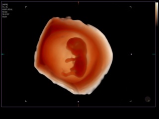 Fetus - early gestation, Realistic Vue, 3D