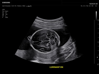 Fetal brain, Luminant™