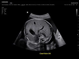 Fetal abdomen, ClearVision