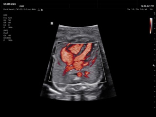 Fetal heart, MV-Flow™
