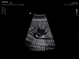 Fetal heart, Luminant™