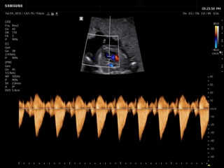 Fetal heart (LVOT), CFM & PW