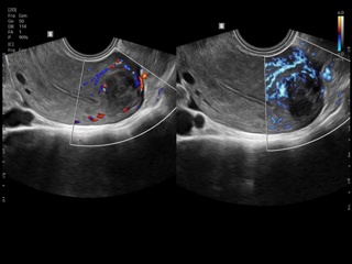Uterine fibroids, CFM & MV-Flow