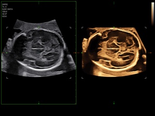 Fetal brain, Slice A