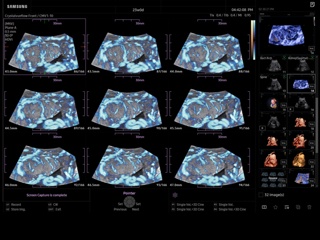Placenta, MSV & MV-Flow